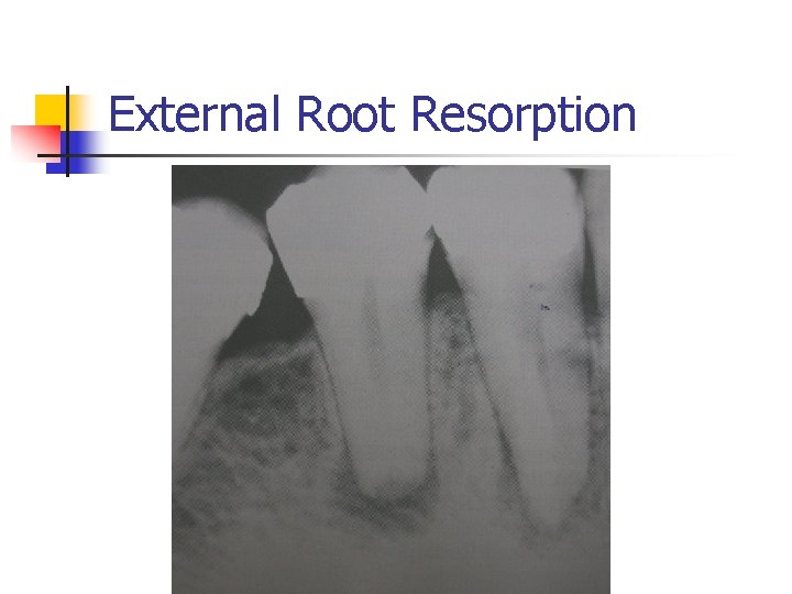 External Root Resorption 