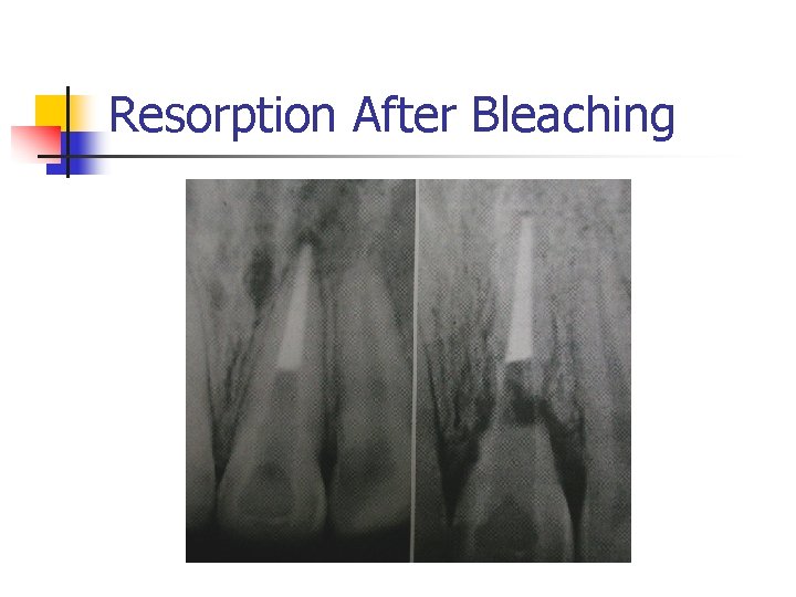 Resorption After Bleaching 