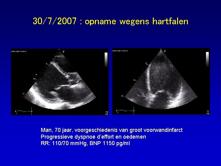 30/7/2007 : opname wegens hartfalen Man, 70 jaar, voorgeschiedenis van groot voorwandinfarct Progressieve dyspnoe