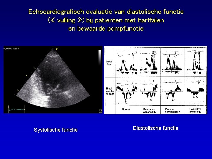Echocardiografisch evaluatie van diastolische functie ( « vulling » ) bij patienten met hartfalen
