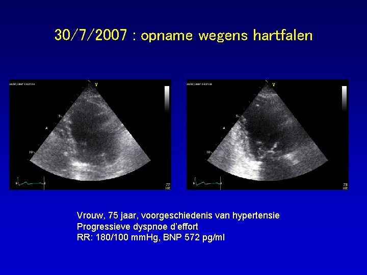 30/7/2007 : opname wegens hartfalen Vrouw, 75 jaar, voorgeschiedenis van hypertensie Progressieve dyspnoe d’effort