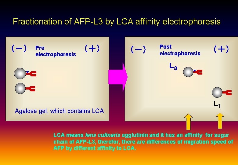 Fractionation of AFP-L 3 by LCA affinity electrophoresis （－） Pre electrophoresis （＋） （－） Post