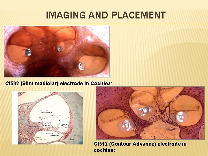 IMAGING AND PLACEMENT CI 532 (Slim modiolar) electrode in Cochlea: CI 512 (Contour Advance)