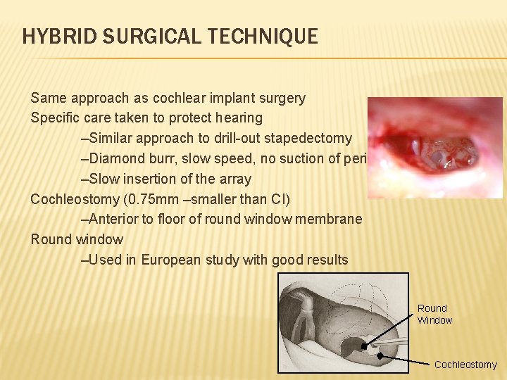 HYBRID SURGICAL TECHNIQUE Same approach as cochlear implant surgery Specific care taken to protect