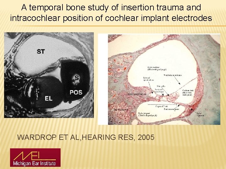 A temporal bone study of insertion trauma and intracochlear position of cochlear implant electrodes