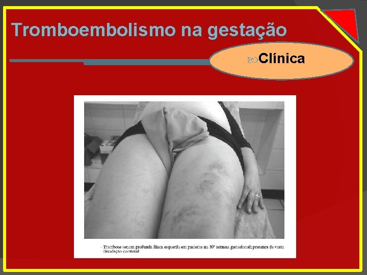 Tromboembolismo na gestação Clínica 