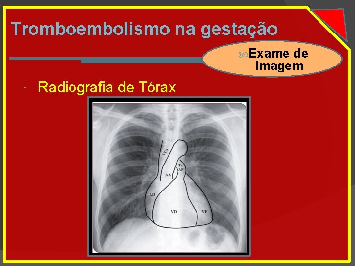 Tromboembolismo na gestação Exame de Imagem Radiografia de Tórax 