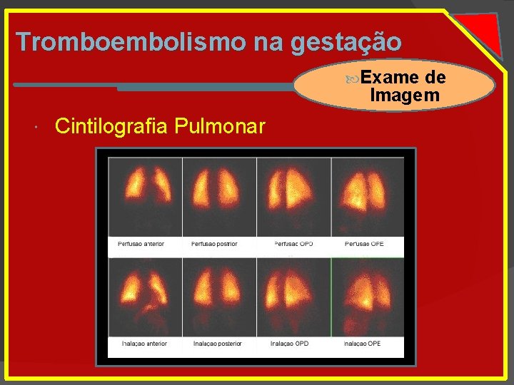 Tromboembolismo na gestação Exame de Imagem Cintilografia Pulmonar 