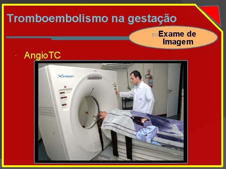 Tromboembolismo na gestação Exame de Imagem Angio. TC 