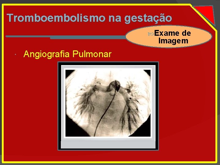Tromboembolismo na gestação Exame de Imagem Angiografia Pulmonar 