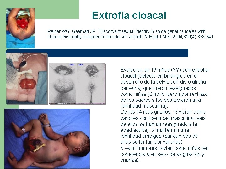 Extrofia cloacal Reiner WG, Gearhart JP. “Discordant sexual identity in some genetics males with