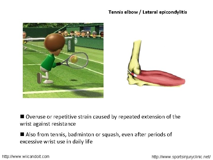 Tennis elbow / Lateral epicondylitis n Overuse or repetitive strain caused by repeated extension