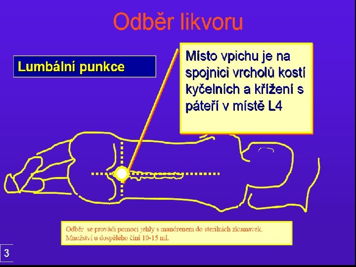 n Odběr likvoru. VYŠETŘENÍ LIKVORU KATEŘINA MRÁZOVÁVYŠETŘENÍ LIKVORU MRÁZOVÁKATEŘINA MRÁZOVÁ33 Místo vpichu je na