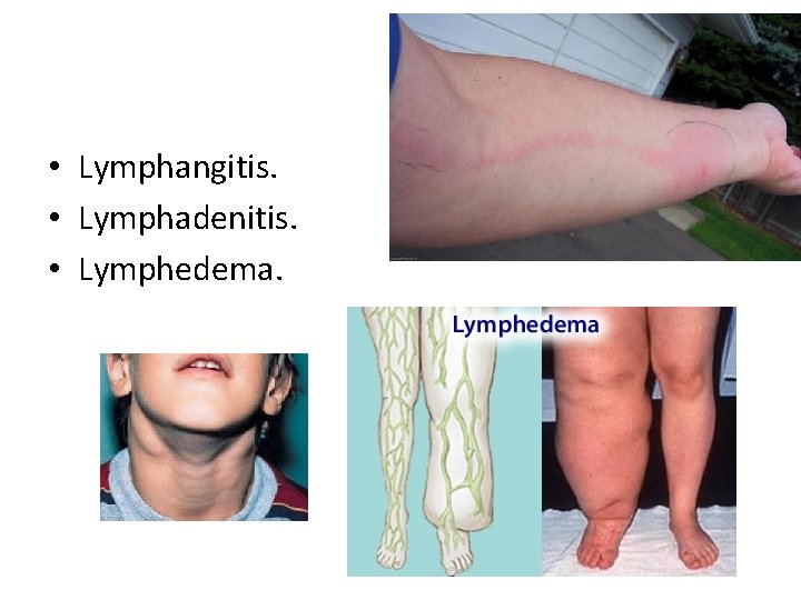 • Lymphangitis. • Lymphadenitis. • Lymphedema. 