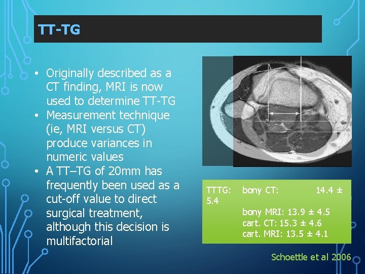 TT-TG • Originally described as a CT finding, MRI is now used to determine
