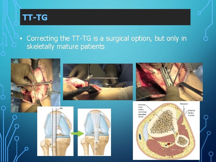 TT-TG • Correcting the TT-TG is a surgical option, but only in skeletally mature