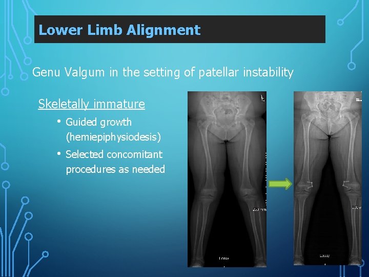 Lower Limb Alignment Genu Valgum in the setting of patellar instability Skeletally immature •