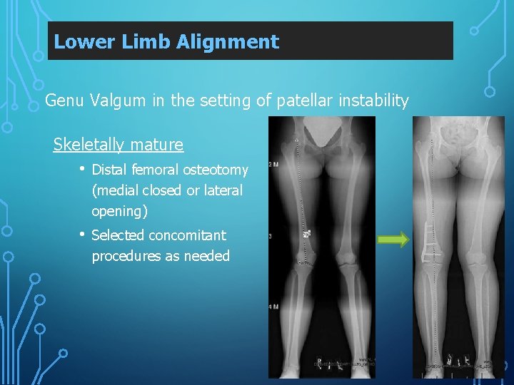 Lower Limb Alignment Genu Valgum in the setting of patellar instability Skeletally mature •