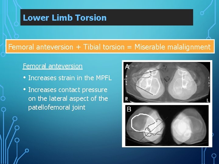 Lower Limb Torsion Femoral anteversion + Tibial torsion = Miserable malalignment Femoral anteversion •