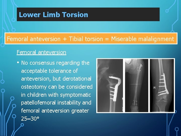 Lower Limb Torsion Femoral anteversion + Tibial torsion = Miserable malalignment Femoral anteversion •