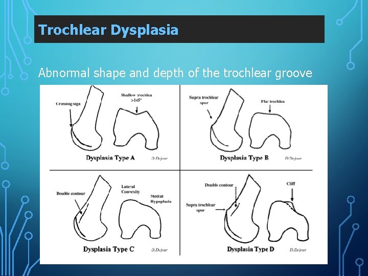 Trochlear Dysplasia Abnormal shape and depth of the trochlear groove 