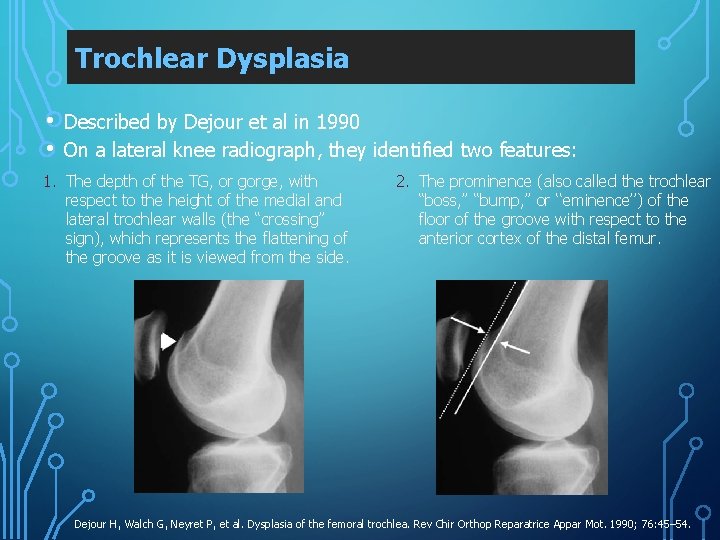 Trochlear Dysplasia • • Described by Dejour et al in 1990 On a lateral