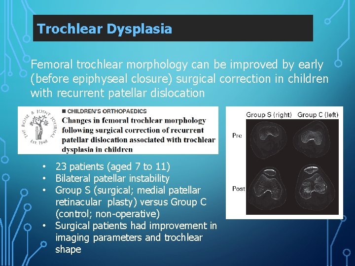 Trochlear Dysplasia Femoral trochlear morphology can be improved by early (before epiphyseal closure) surgical