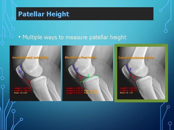 Patellar Height • Multiple ways to measure patellar height 