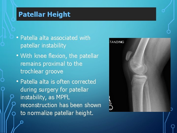 Patellar Height • Patella alta associated with patellar instability • With knee flexion, the