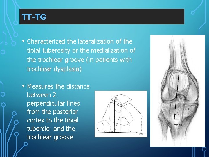 TT-TG • Characterized the lateralization of the tibial tuberosity or the medialization of the