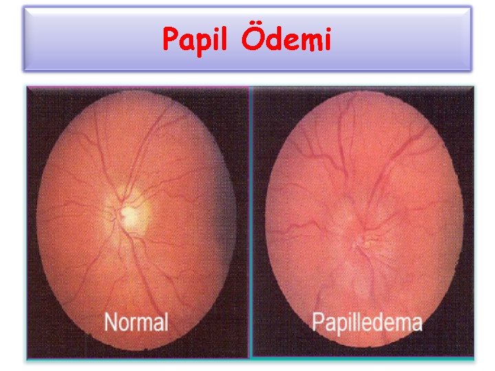 Papil Ödemi 