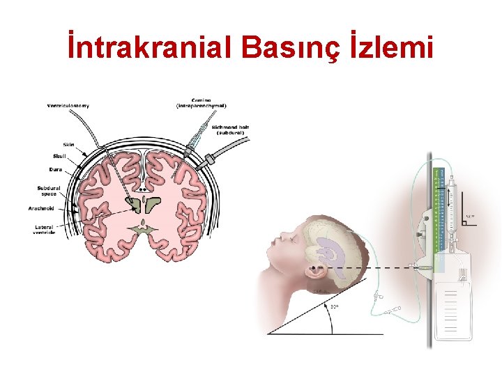 İntrakranial Basınç İzlemi 