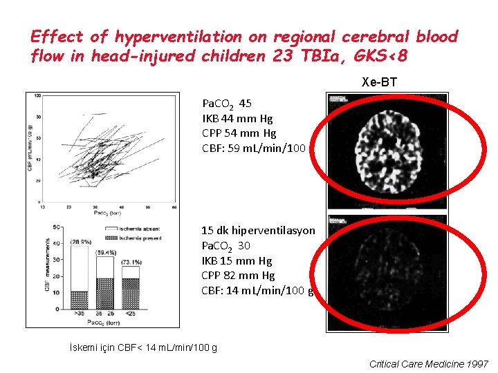 Effect of hyperventilation on regional cerebral blood flow in head-injured children 23 TBIa, GKS<8