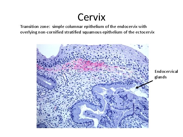 Cervix Transition zone: simple columnar epithelium of the endocervix with overlying non-cornified stratified squamous