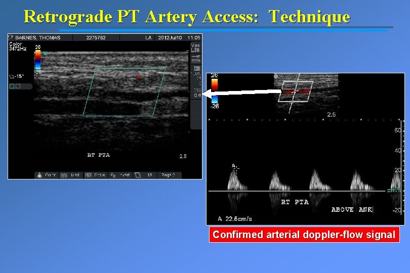 Retrograde PT Artery Access: Technique Confirmed arterial doppler-flow signal 