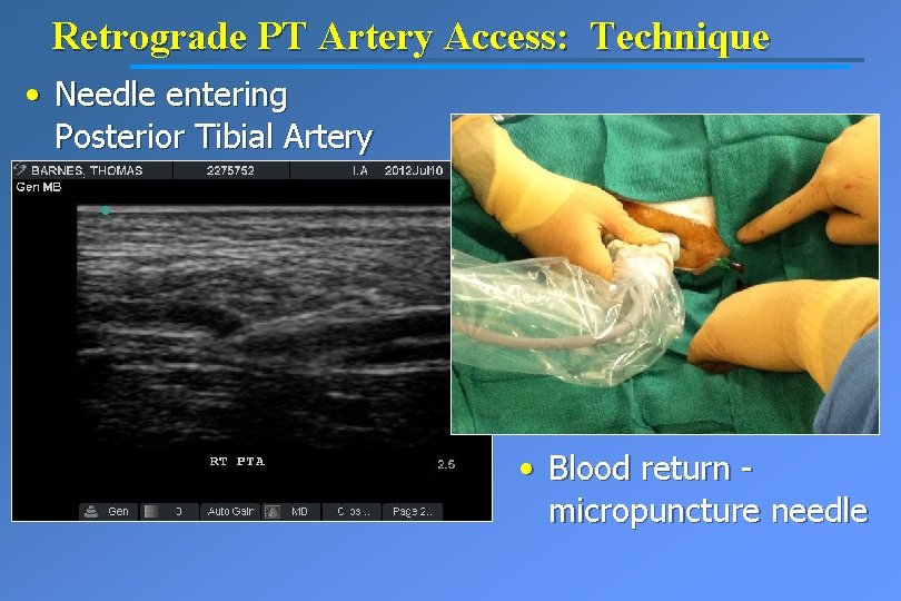 Retrograde PT Artery Access: Technique • Needle entering Posterior Tibial Artery • Blood return
