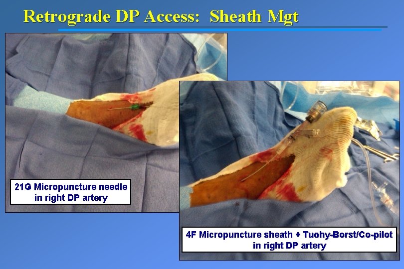Retrograde DP Access: Sheath Mgt 21 G Micropuncture needle in right DP artery 4