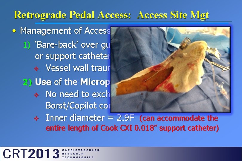Retrograde Pedal Access: Access Site Mgt • Management of Access Site-Sheath Options: 1) ‘Bare-back’