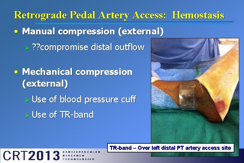 Retrograde Pedal Artery Access: Hemostasis • Manual compression (external) Ø ? ? compromise distal