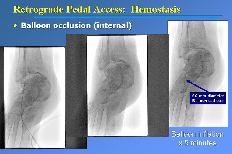 Retrograde Pedal Access: Hemostasis • Balloon occlusion (internal) 2. 0 -mm diameter Balloon catheter