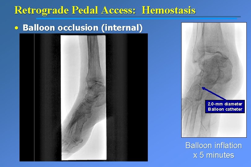 Retrograde Pedal Access: Hemostasis • Balloon occlusion (internal) 2. 0 -mm diameter Balloon catheter
