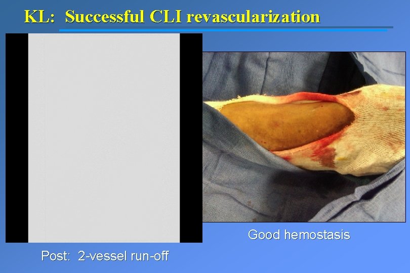 KL: Successful CLI revascularization Good hemostasis Post: 2 -vessel run-off 