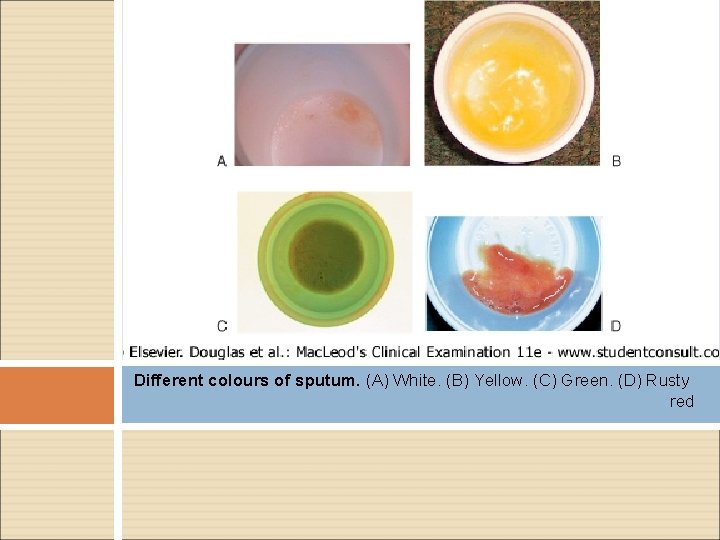 Different colours of sputum. (A) White. (B) Yellow. (C) Green. (D) Rusty red 