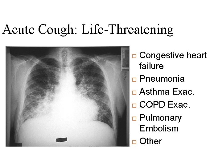 Acute Cough: Life-Threatening Congestive heart failure Pneumonia Asthma Exac. COPD Exac. Pulmonary Embolism Other