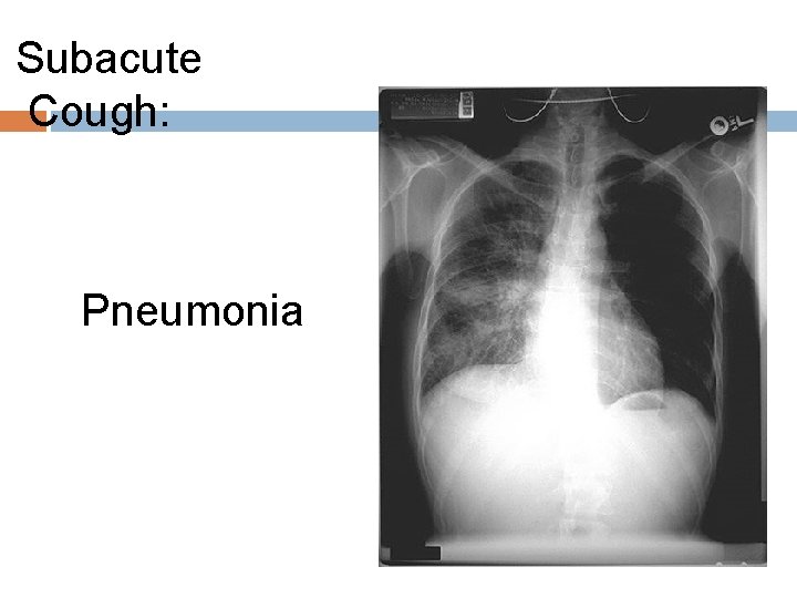 Subacute Cough: Pneumonia 