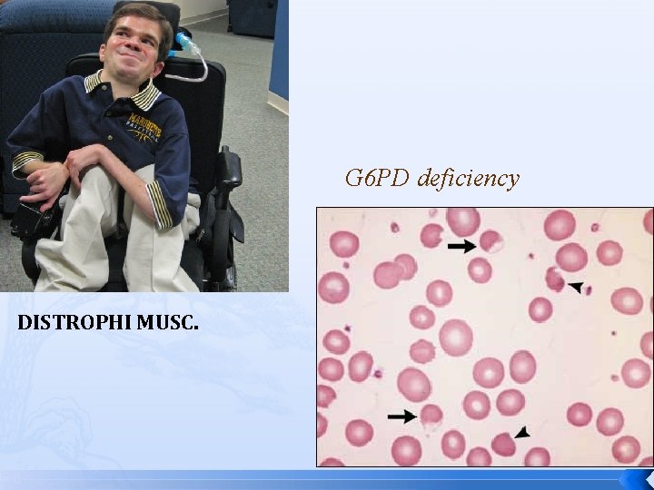 G 6 PD deficiency DISTROPHI MUSC. 