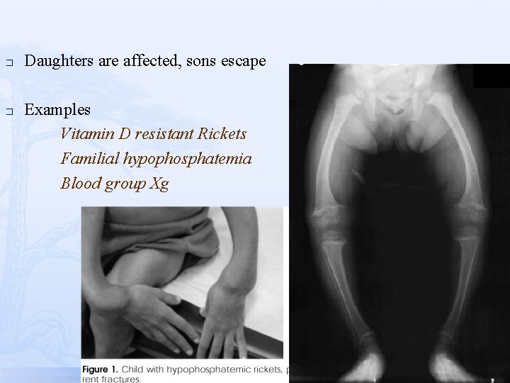 � � Daughters are affected, sons escape Examples Vitamin D resistant Rickets Familial hypophosphatemia