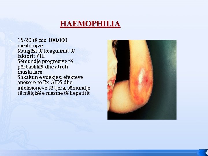 HAEMOPHILIA 15 -20 të çdo 100. 000 meshkujve Mangësi të koagulimit të faktorit VIII