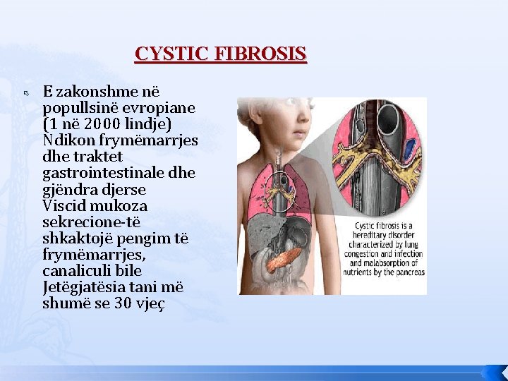 CYSTIC FIBROSIS E zakonshme në popullsinë evropiane (1 në 2000 lindje) Ndikon frymëmarrjes dhe