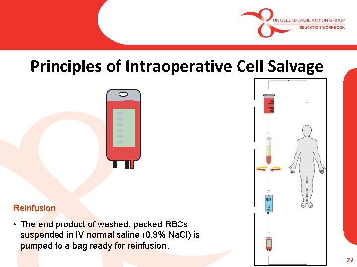 Principles of Intraoperative Cell Salvage Reinfusion • The end product of washed, packed RBCs